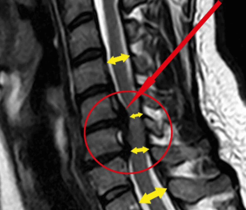 Atención Quiropráctica - Hernia de Disco